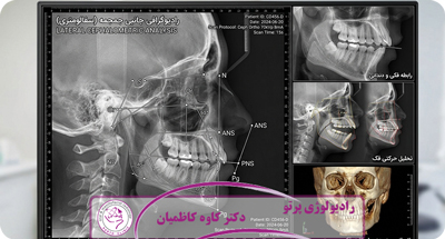 سفالومتری چیست و چه کاربردی در ارتودنسی و جراحی فک دارد؟